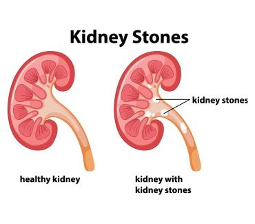 Kidney stones Treatment in Homeopathy - Medicine Care