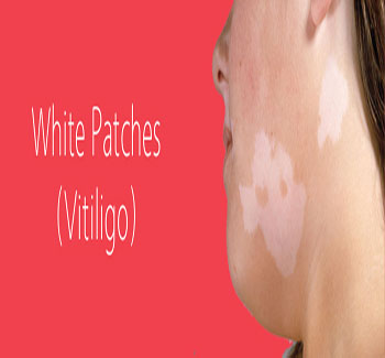 White Patches Homeopathic Medicine - Medicien